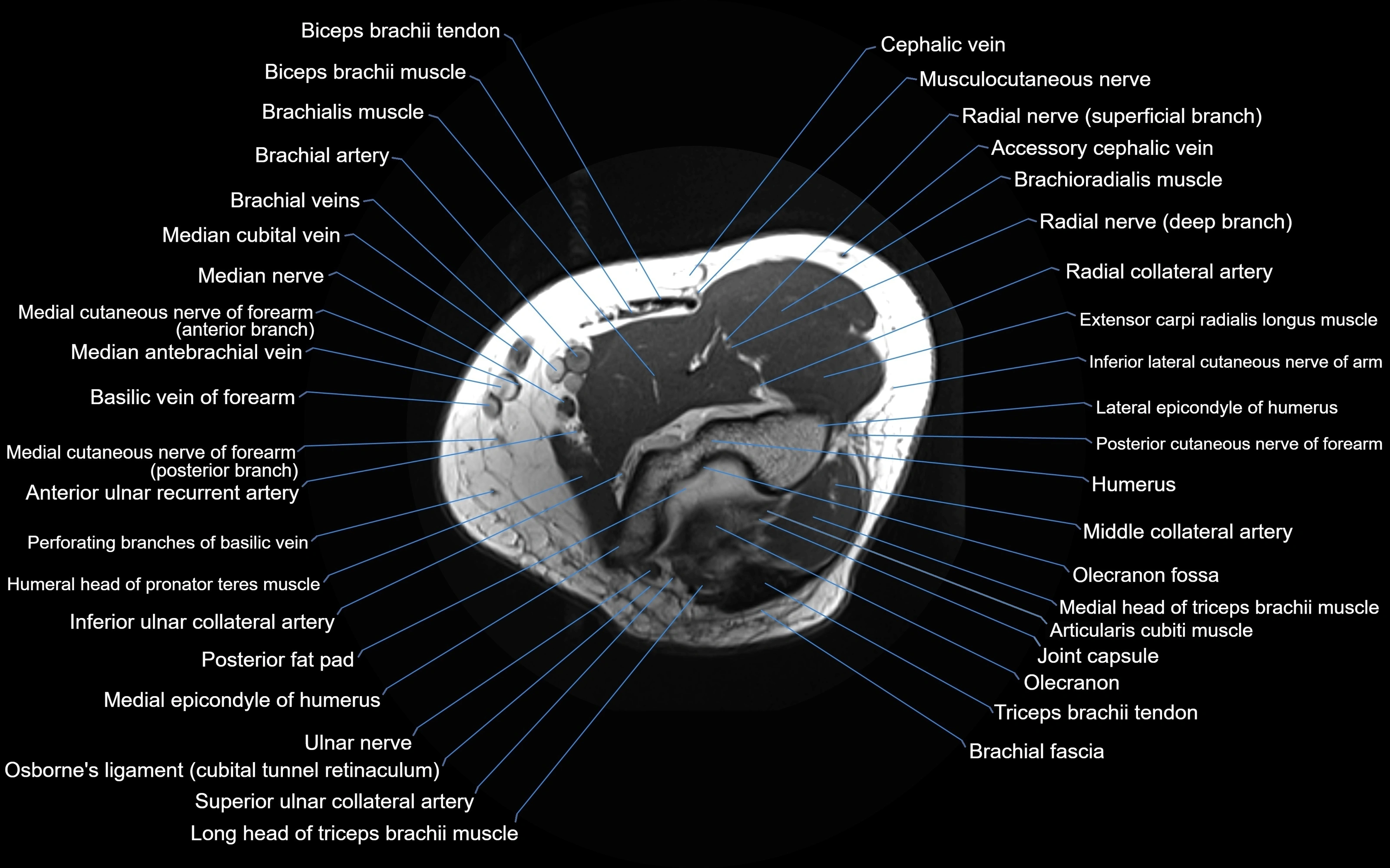 MRI elbow axial cross sectional anatomy 3T  radiology  image-img-00001-00009.webp